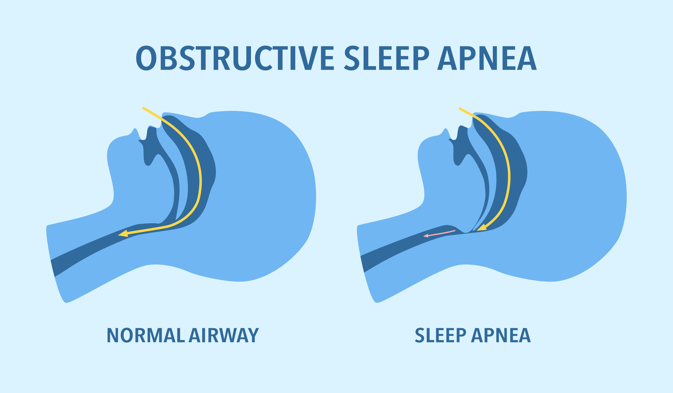 Obstructive sleep apnea diagram