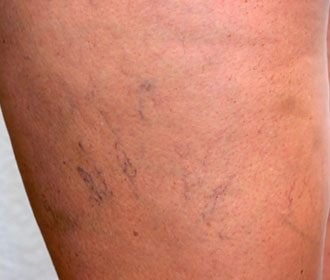 Varicose veins