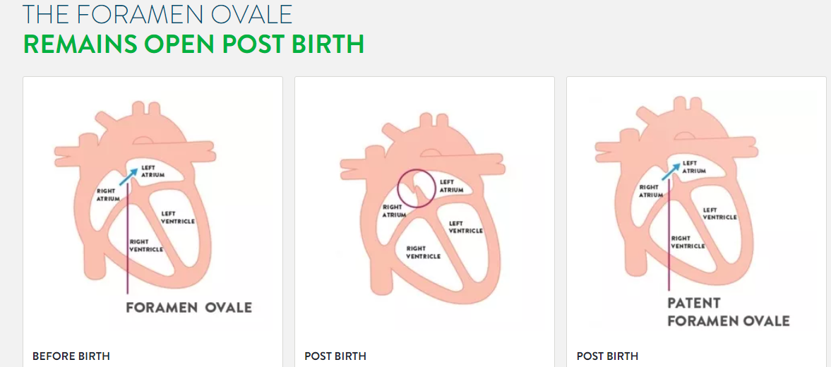 Patent Foramen Ovale (PFO): Symptoms, Causes & Treatment